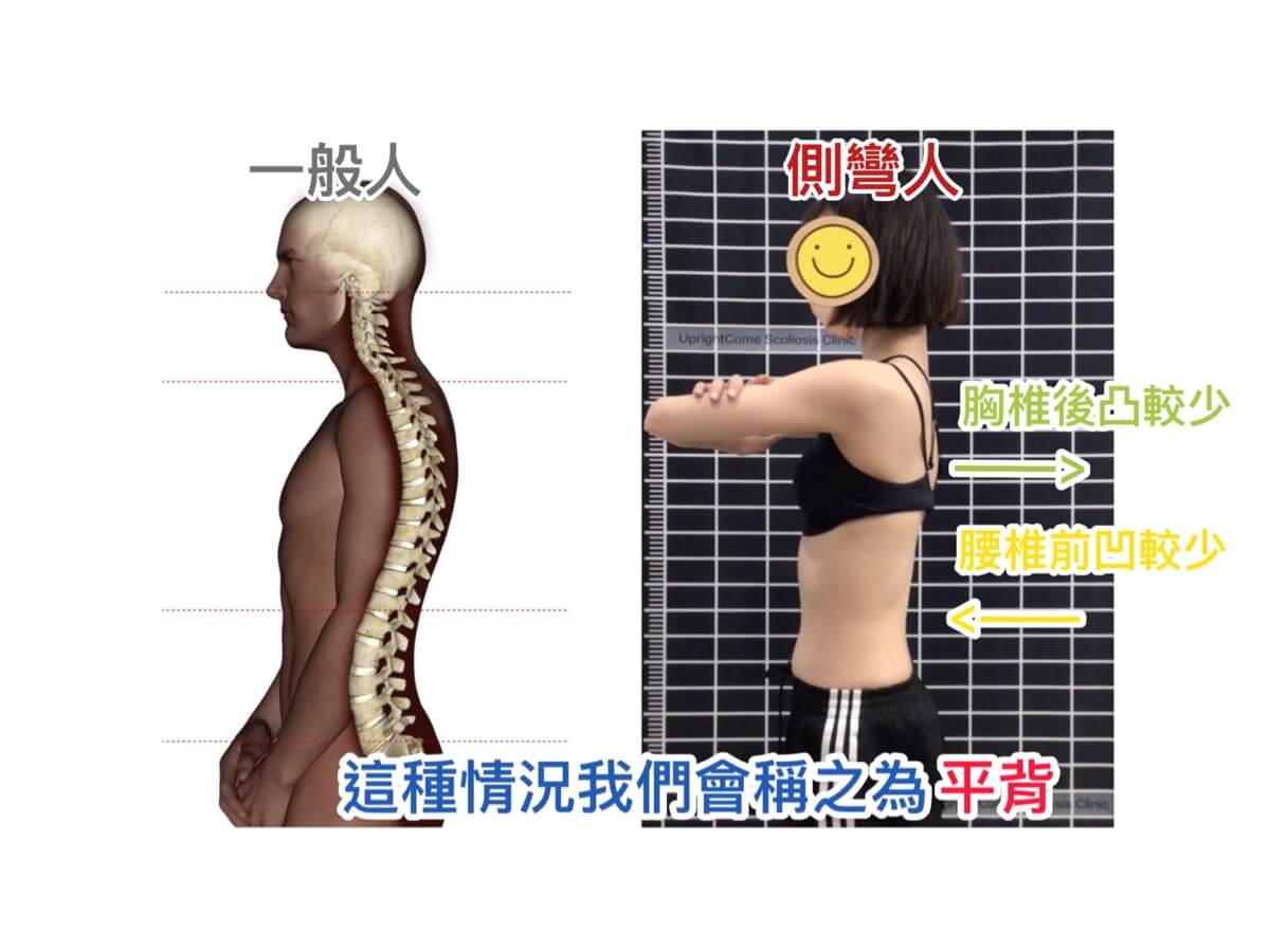 有脊椎側彎，做運動該注意什麼呢？ 挺立康脊椎側彎國際醫療中心